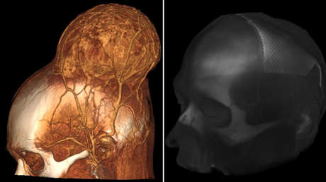 Neurocirujanos rusos extirpan con éxito un enorme tumor cerebral maligno